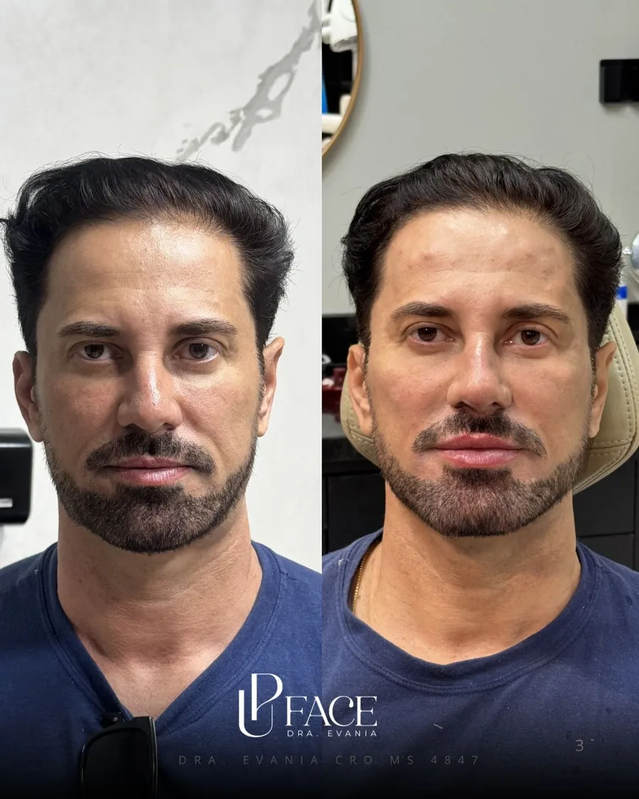Resultado UP Face — antes e depois