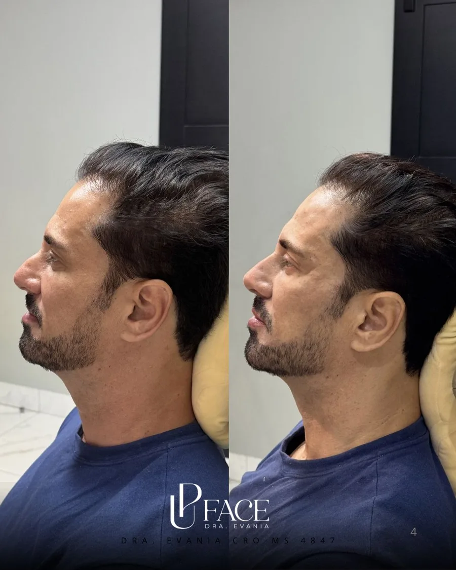 Resultado UP Face — antes e depois