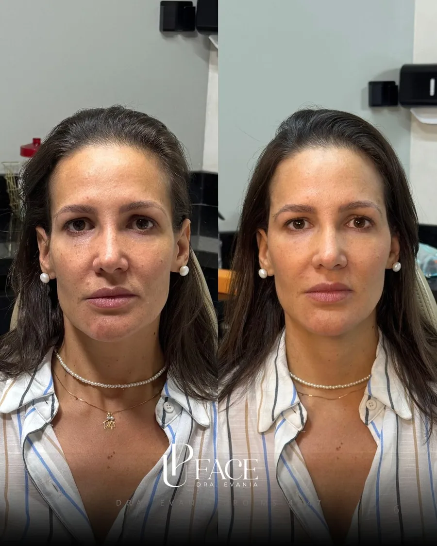 Resultado UP Face — antes e depois