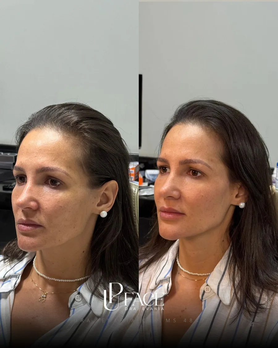 Resultado UP Face — antes e depois