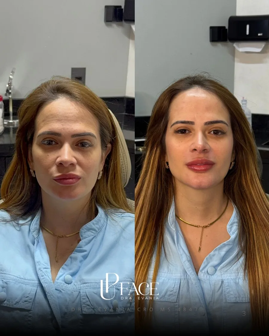 Resultado UP Face — antes e depois