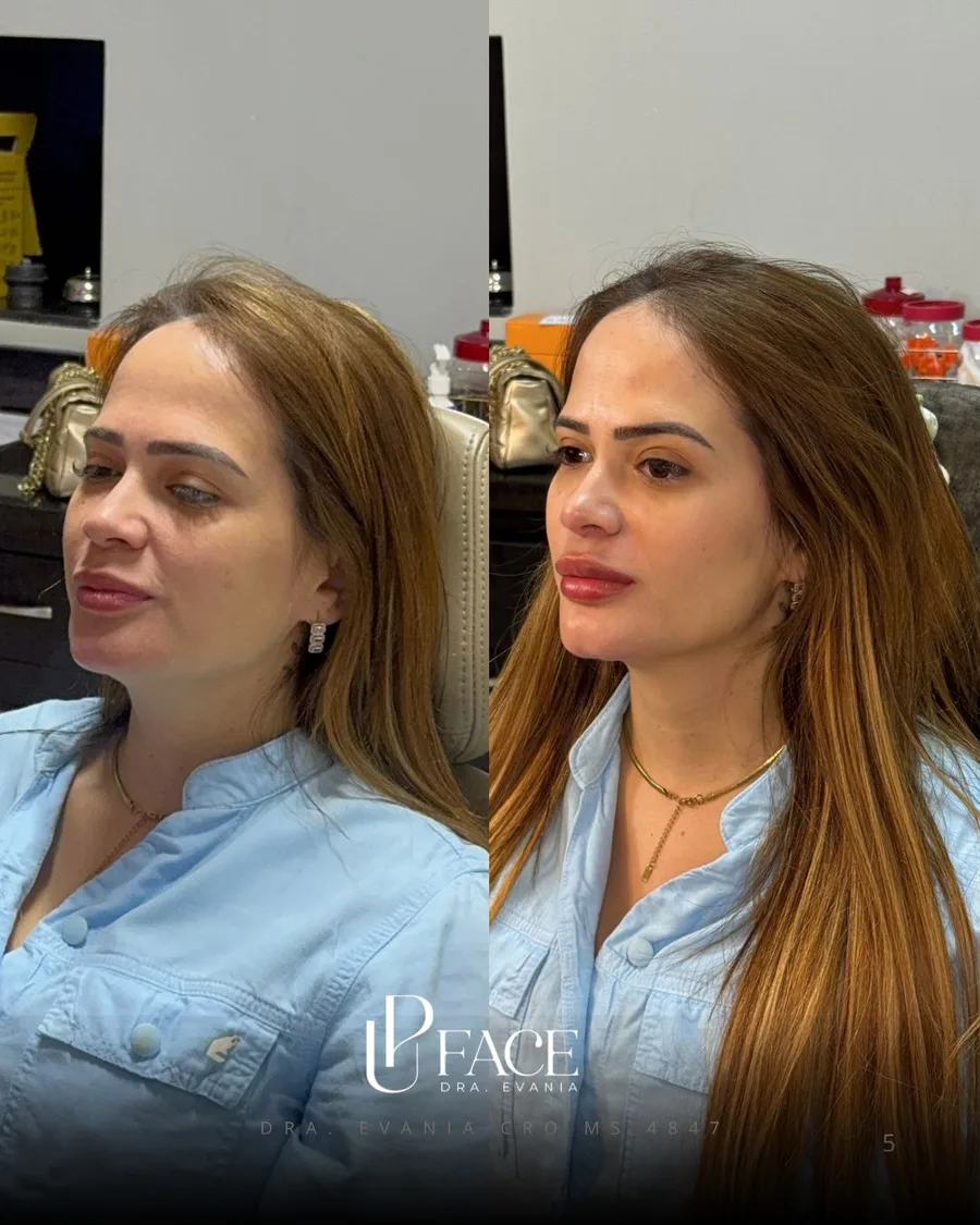 Resultado UP Face — antes e depois