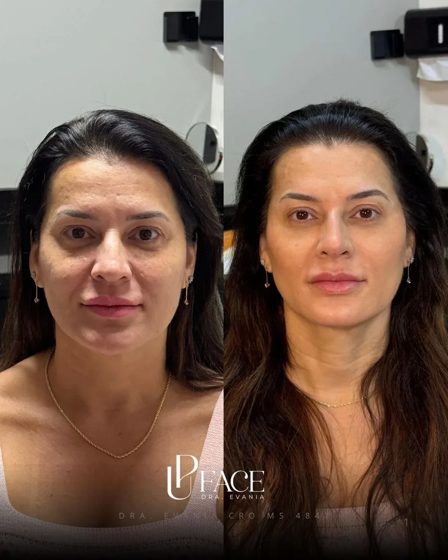 Resultado UP Face — antes e depois