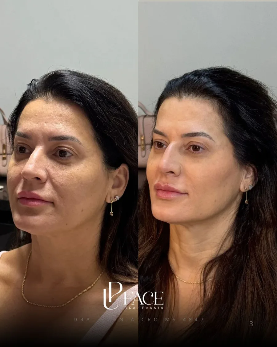 Resultado UP Face — antes e depois